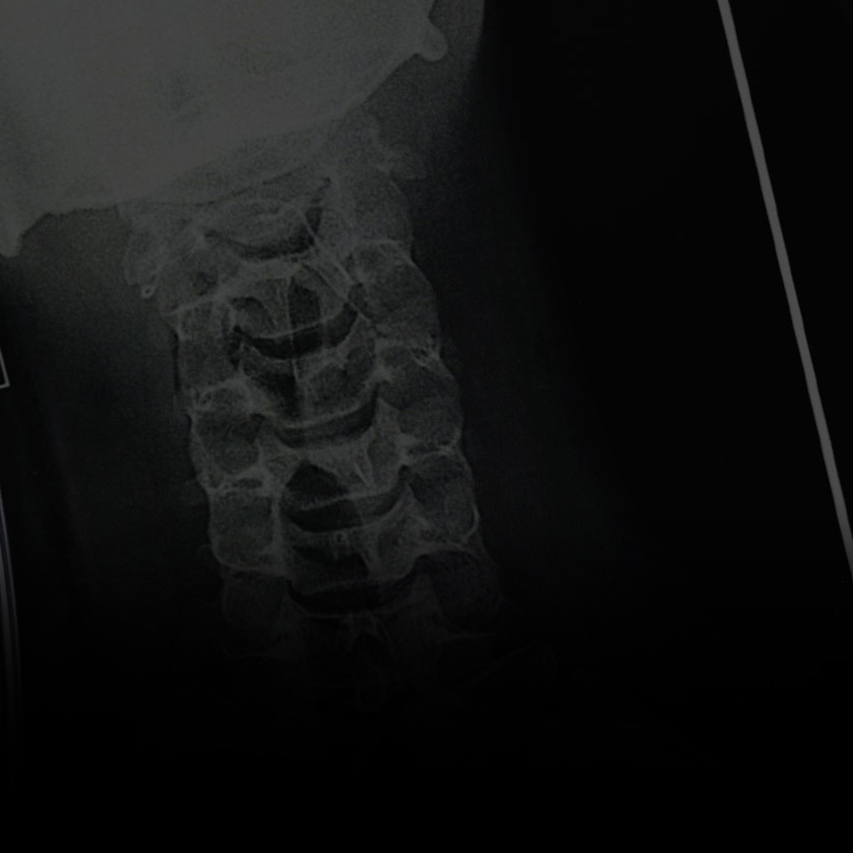 Radiografia di una lesione ossea causata da un incidente