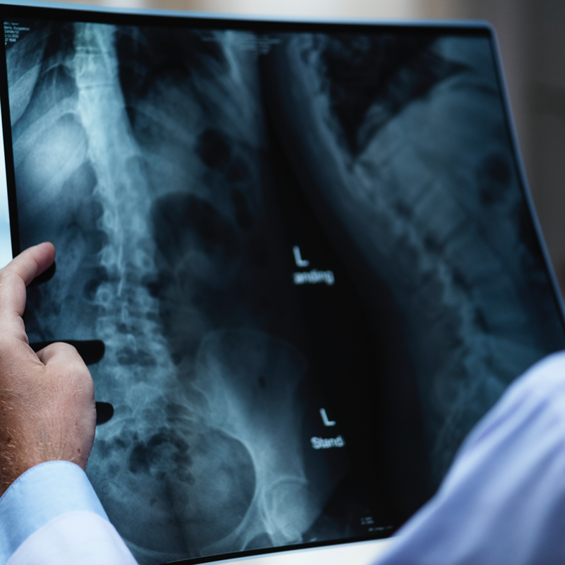 Radiografia di una lesione ossea causata da un incidente